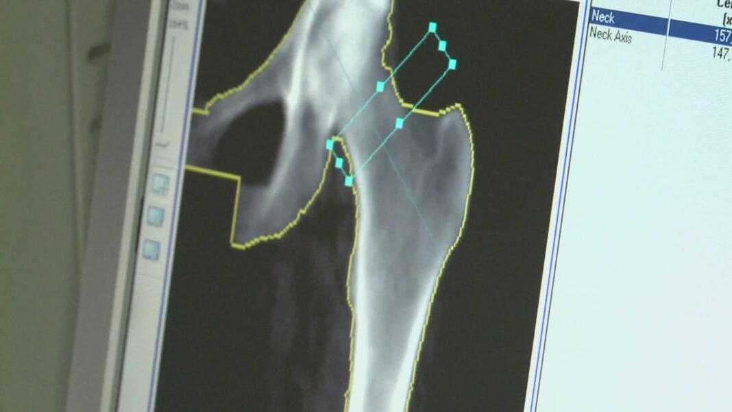 Bone Density, Ozempic Generics, Cortisol Myths, and Hunger. Here are today’s health headlines